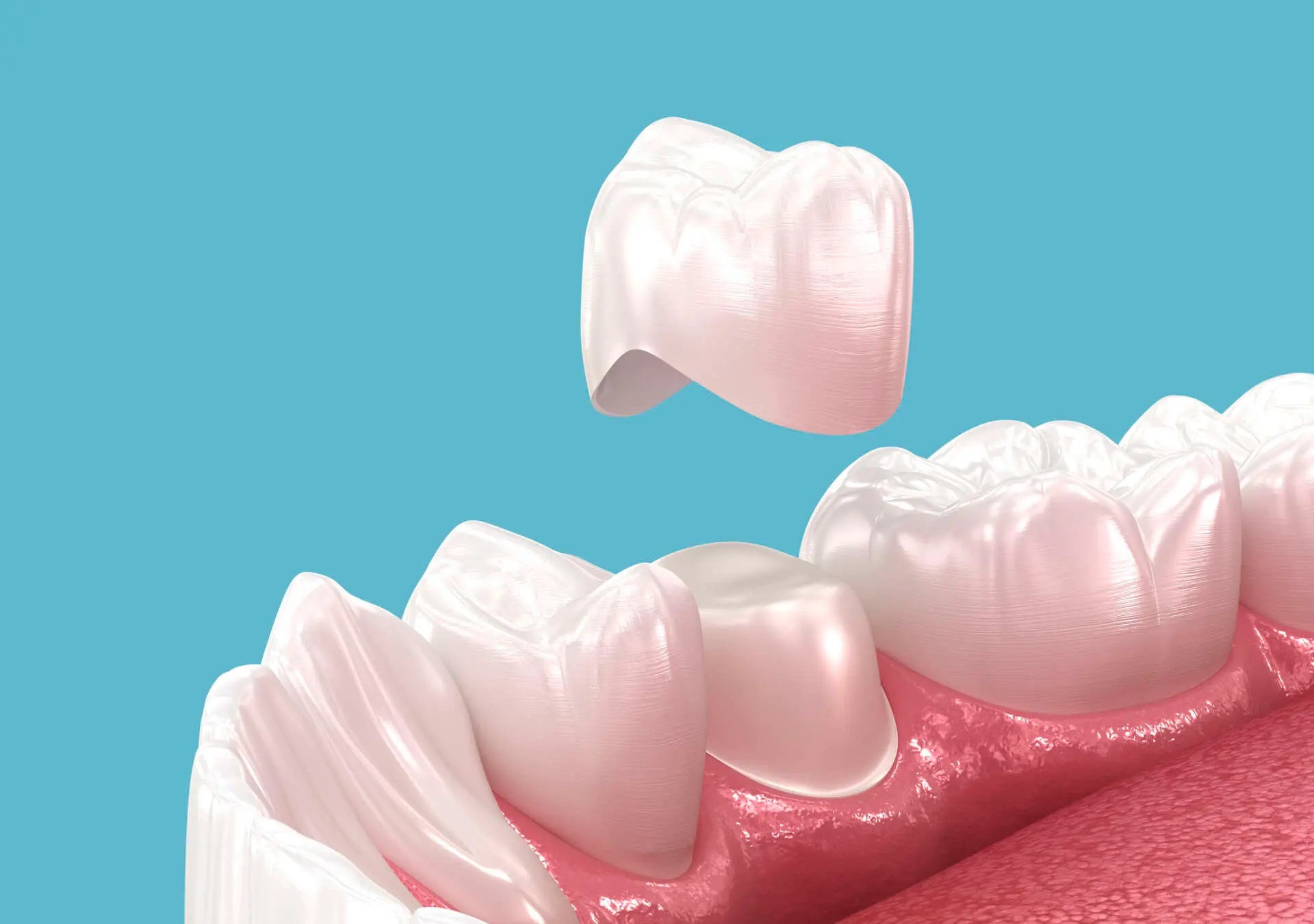 Các loại răng sứ phổ biến