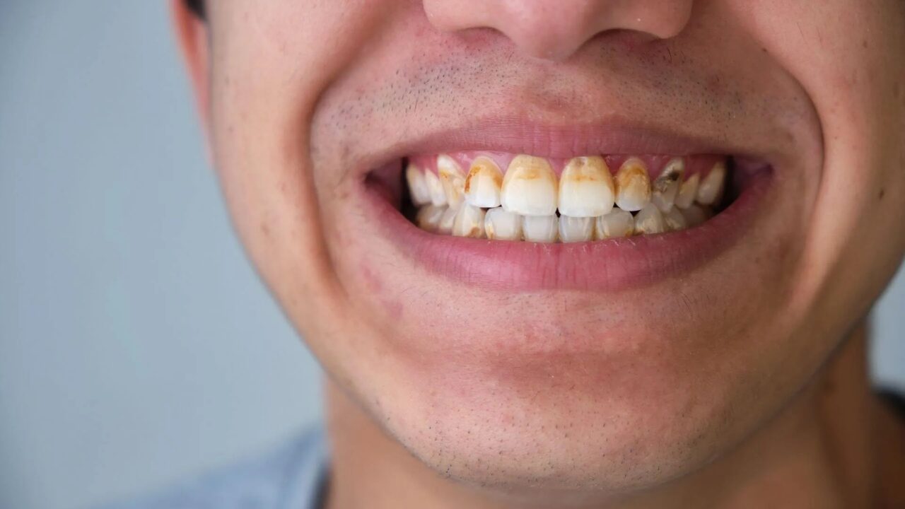 Lấy cao răng hết bao nhiêu tiền