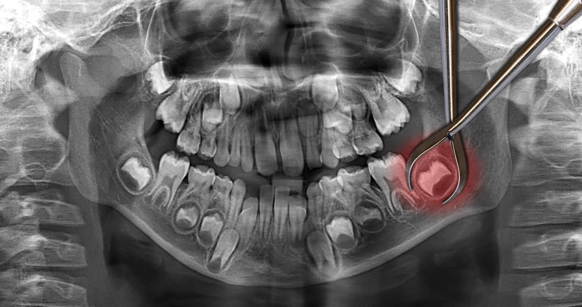 Nhổ răng khôn và những điều cần biết
