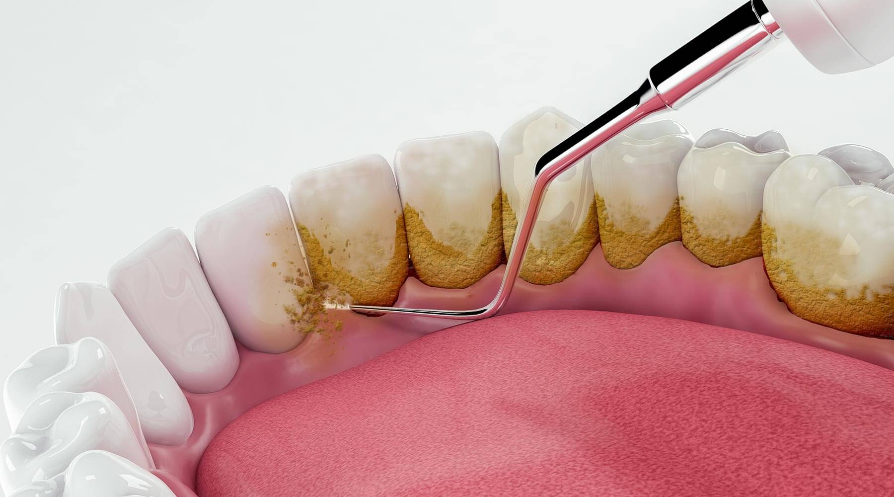Tác hại khi không cạo vôi răng định kỳ