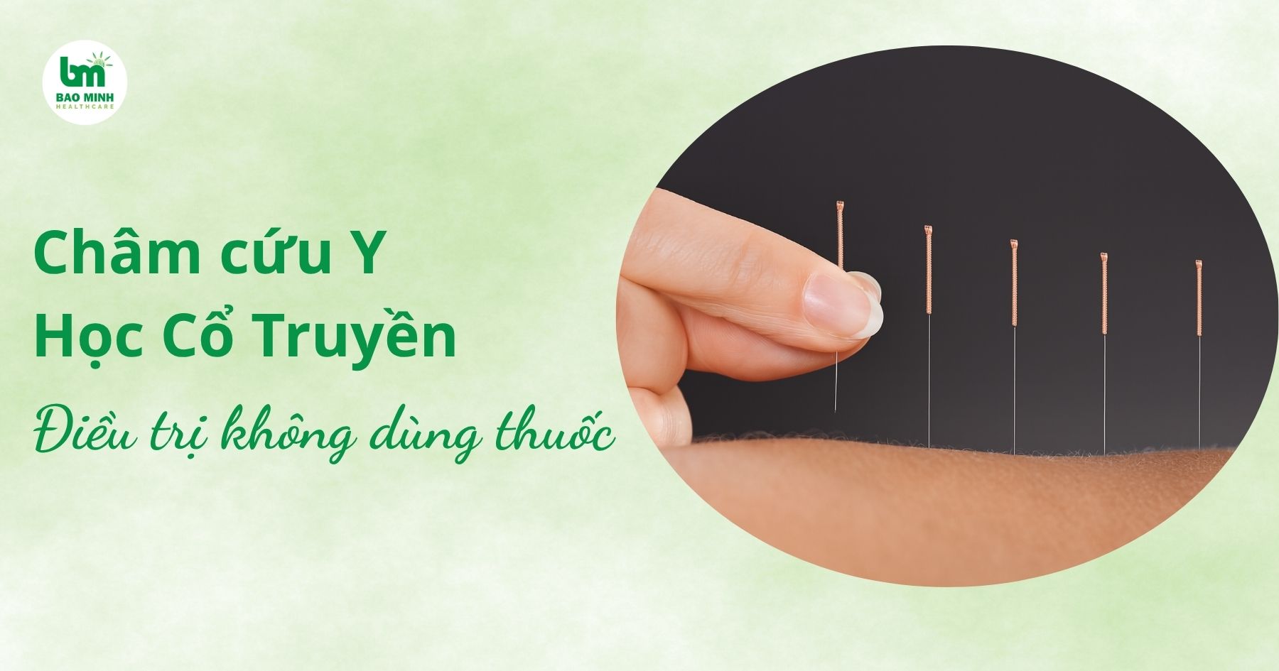 Châm cứu y học cổ truyền
