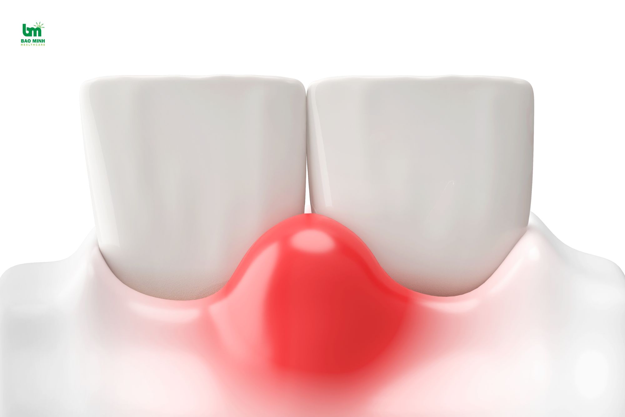 Các yếu tố ảnh hướng đến điều trị viêm nướu