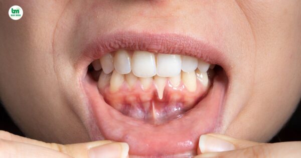 Điều trị viêm nướu giá bao nhiêu, bảng giá tham khảo