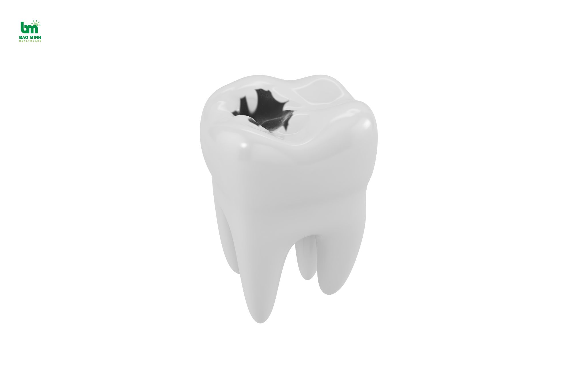Răng sâu và lý do cần điều trị sớm