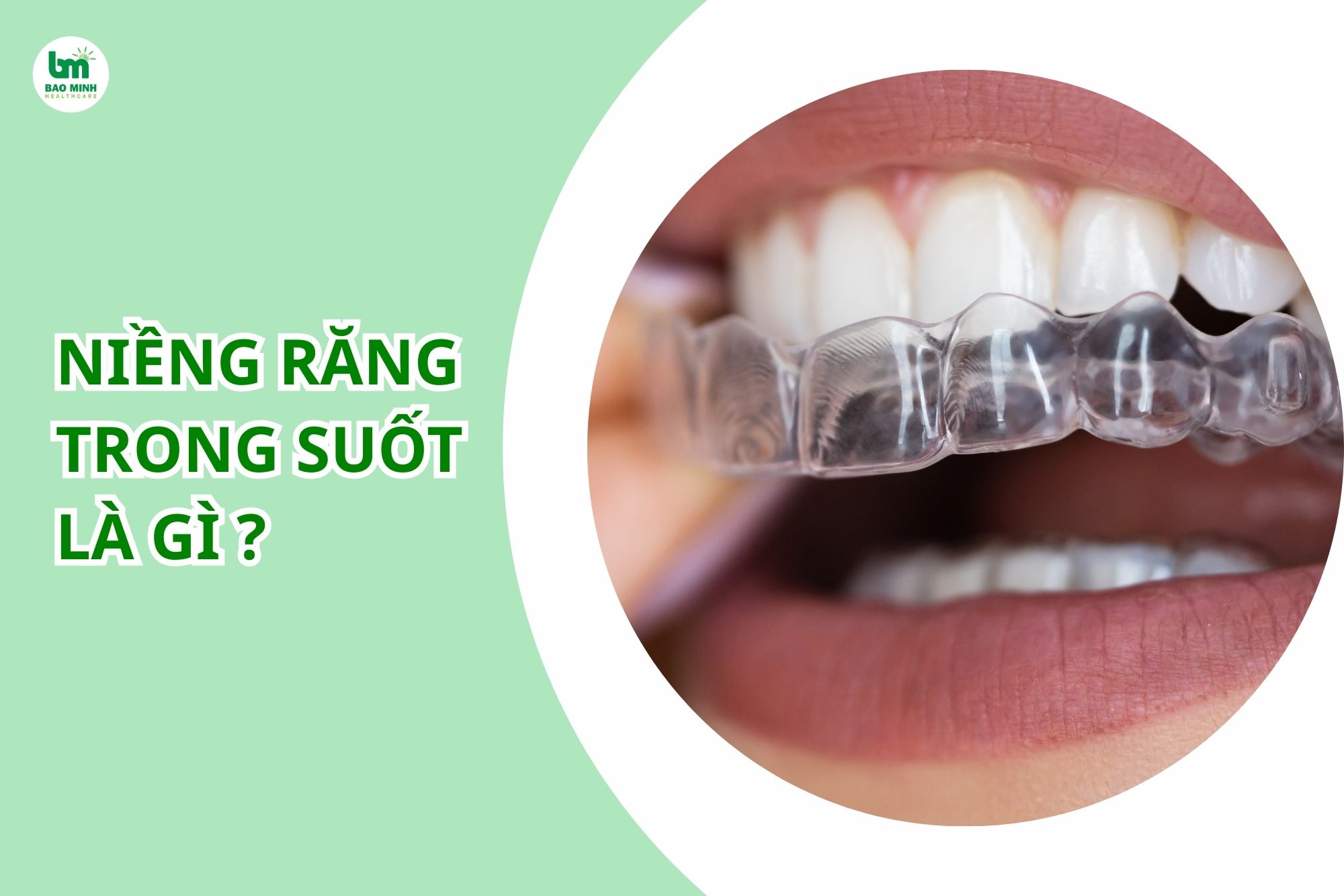 Niềng răng trong suốt là gì